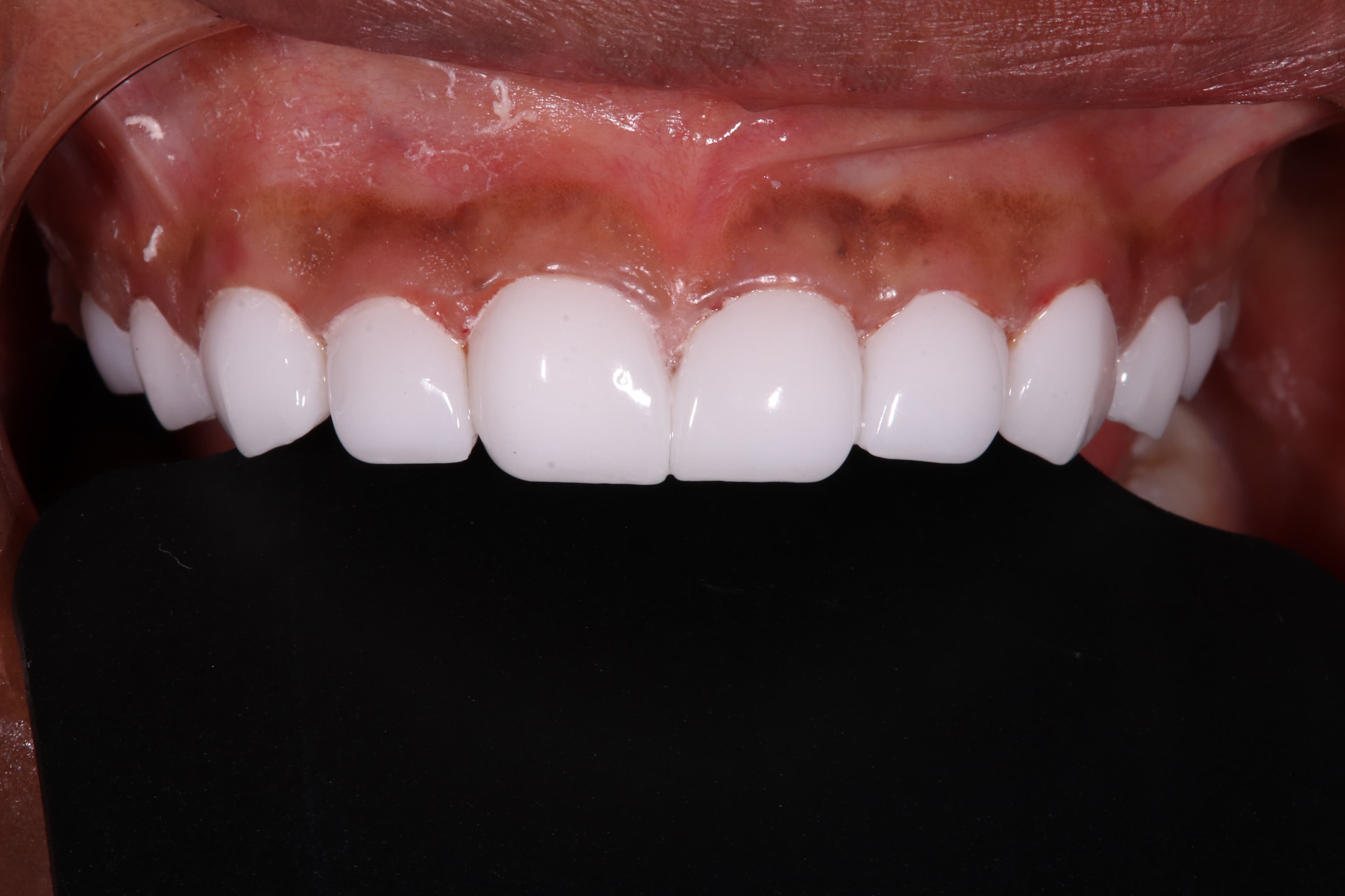 After: Veneers