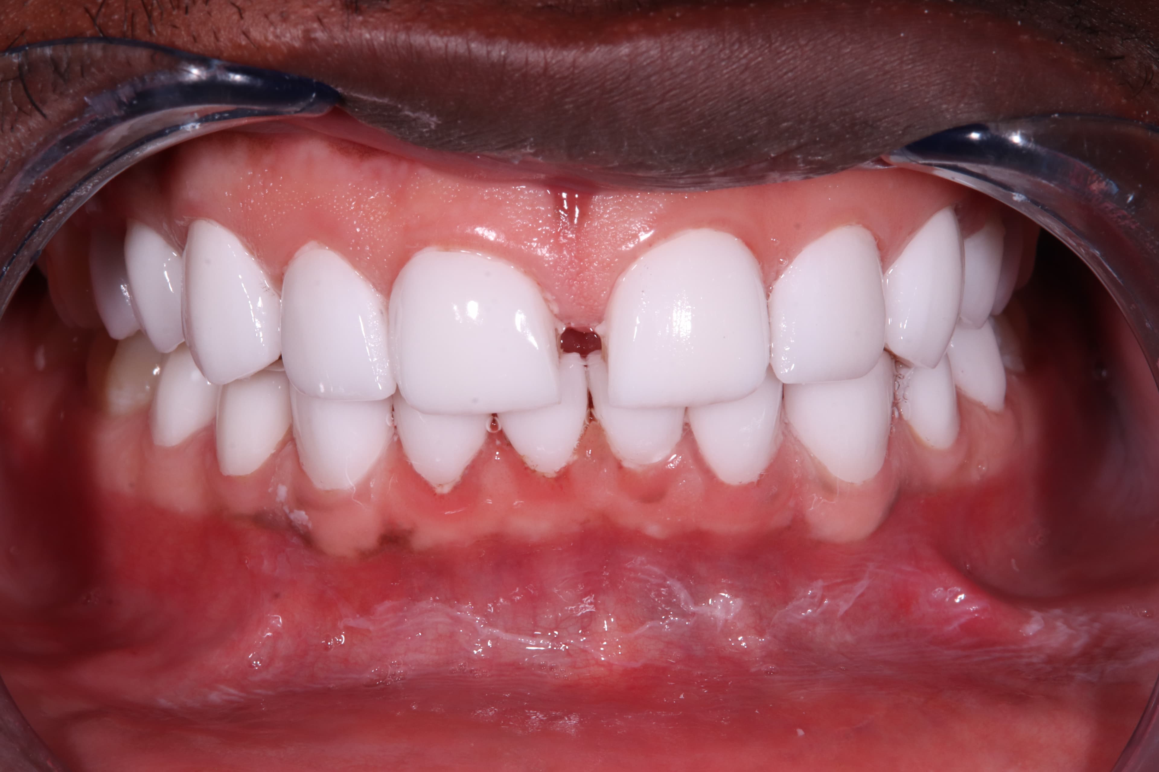 After: Veneers