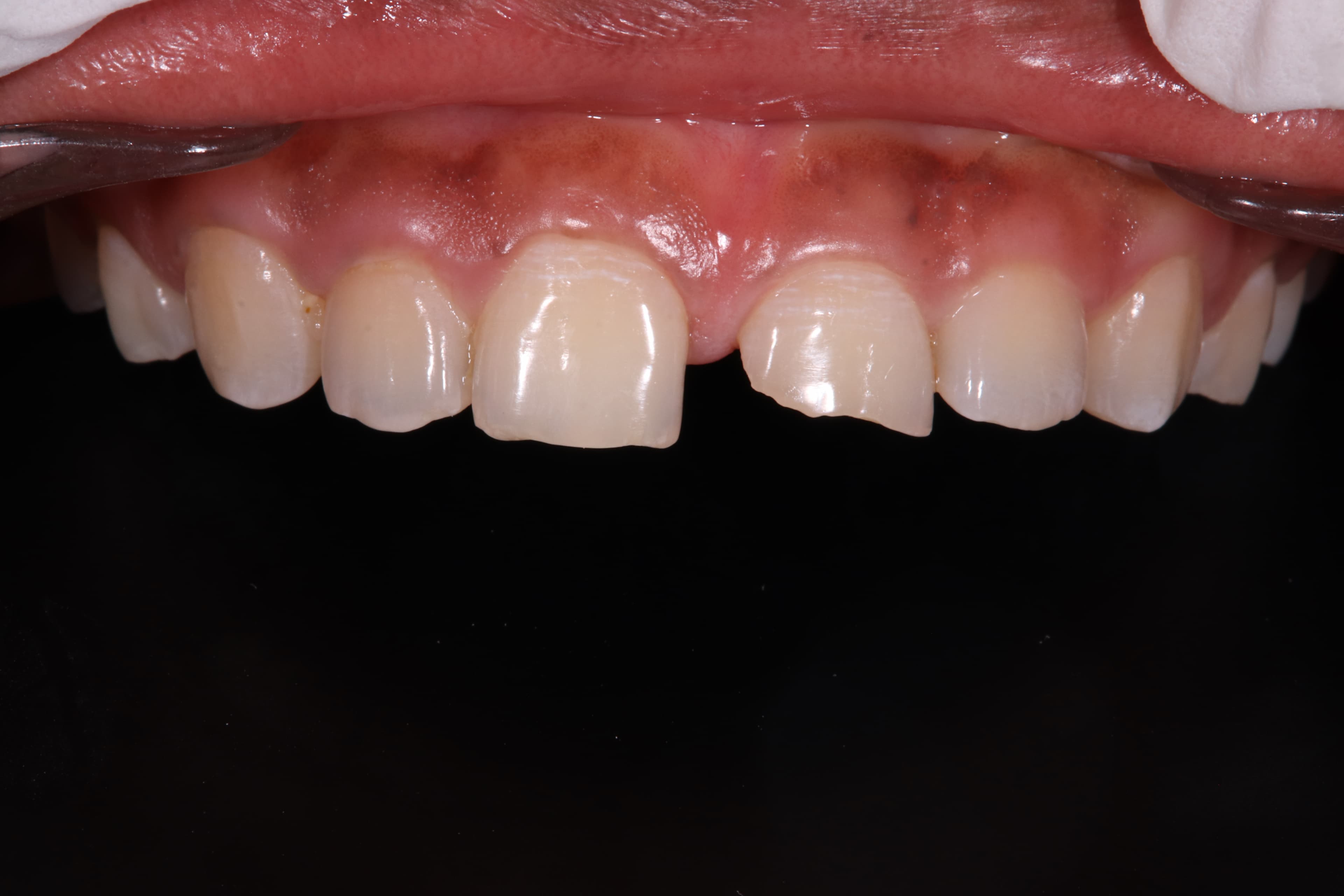Before: Veneers