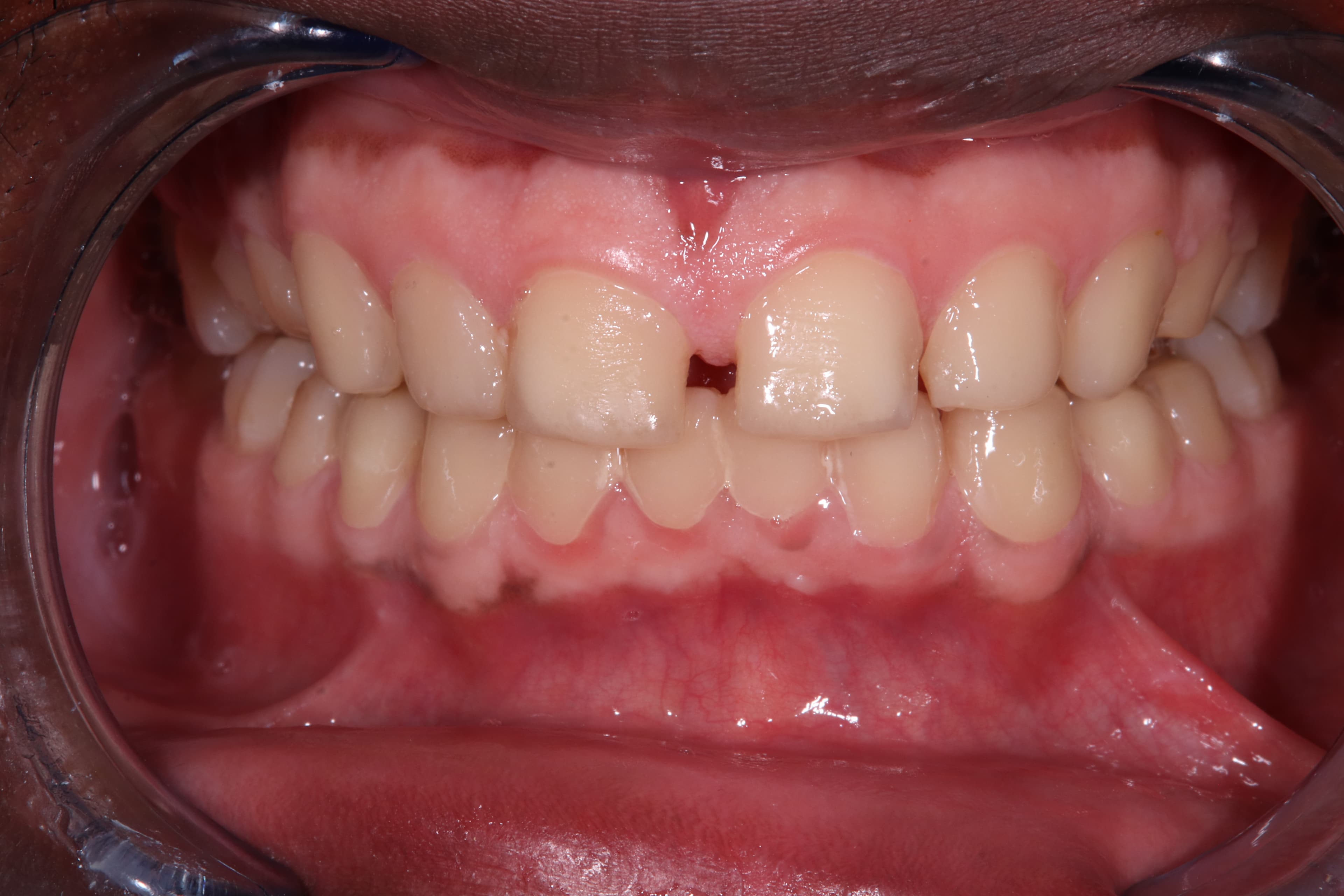 Before: Veneers