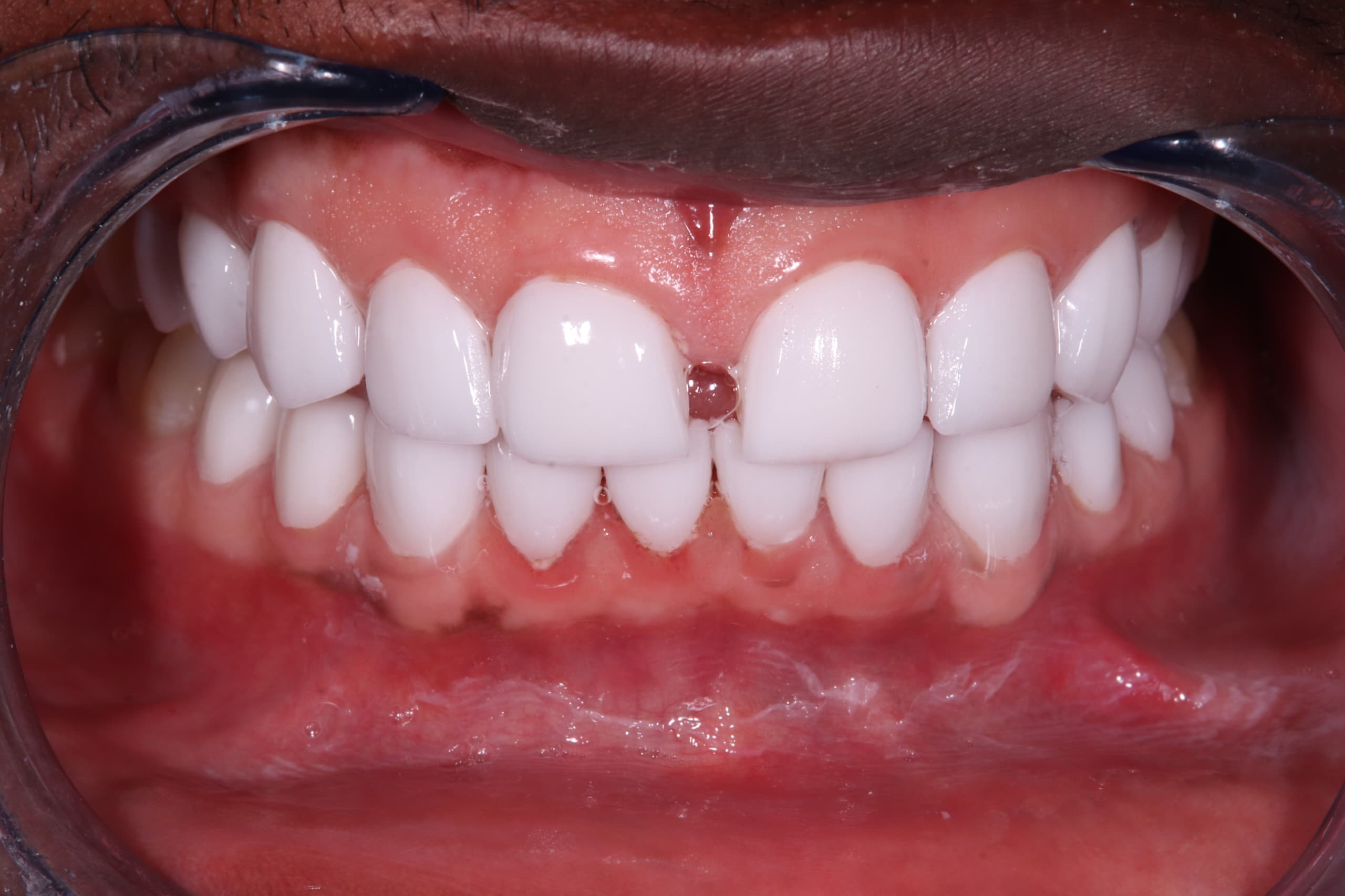 After treatment