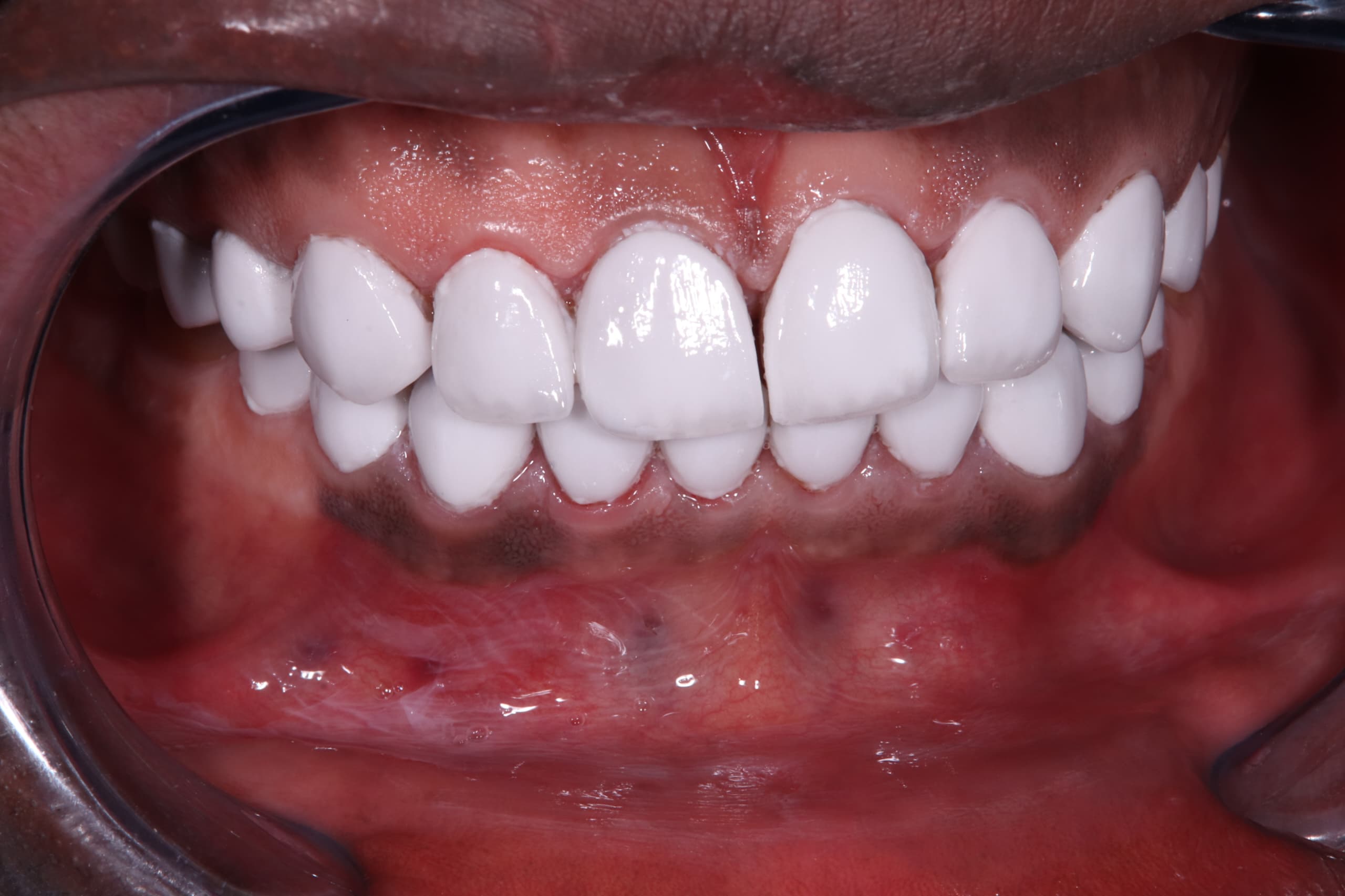 After treatment