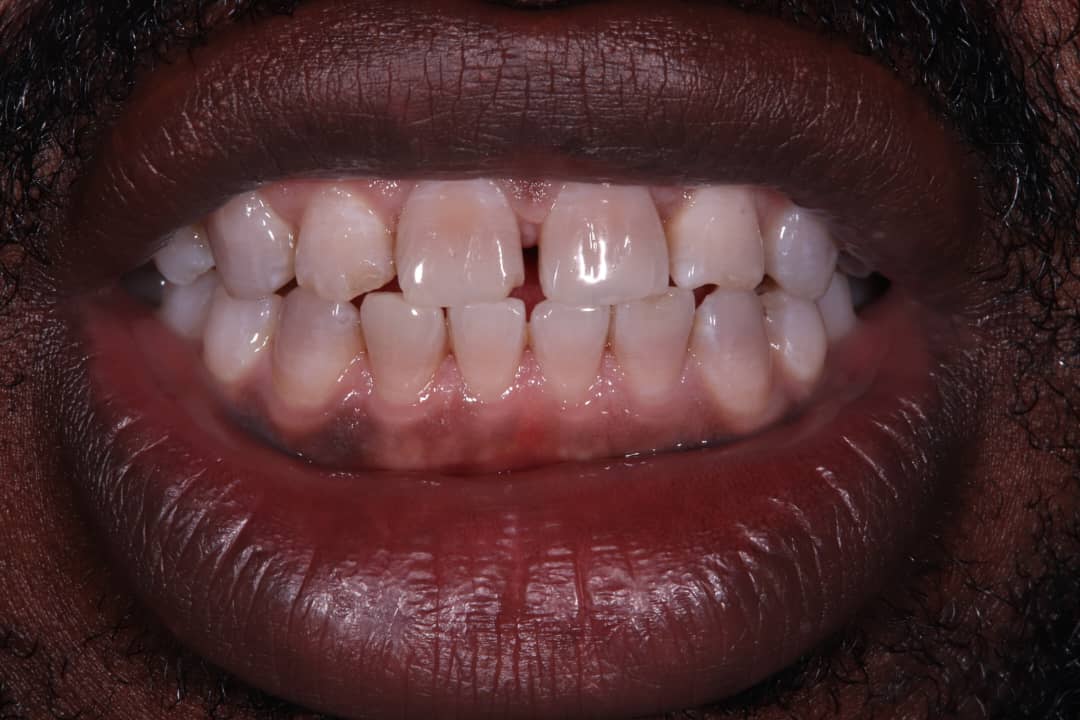 Before treatment