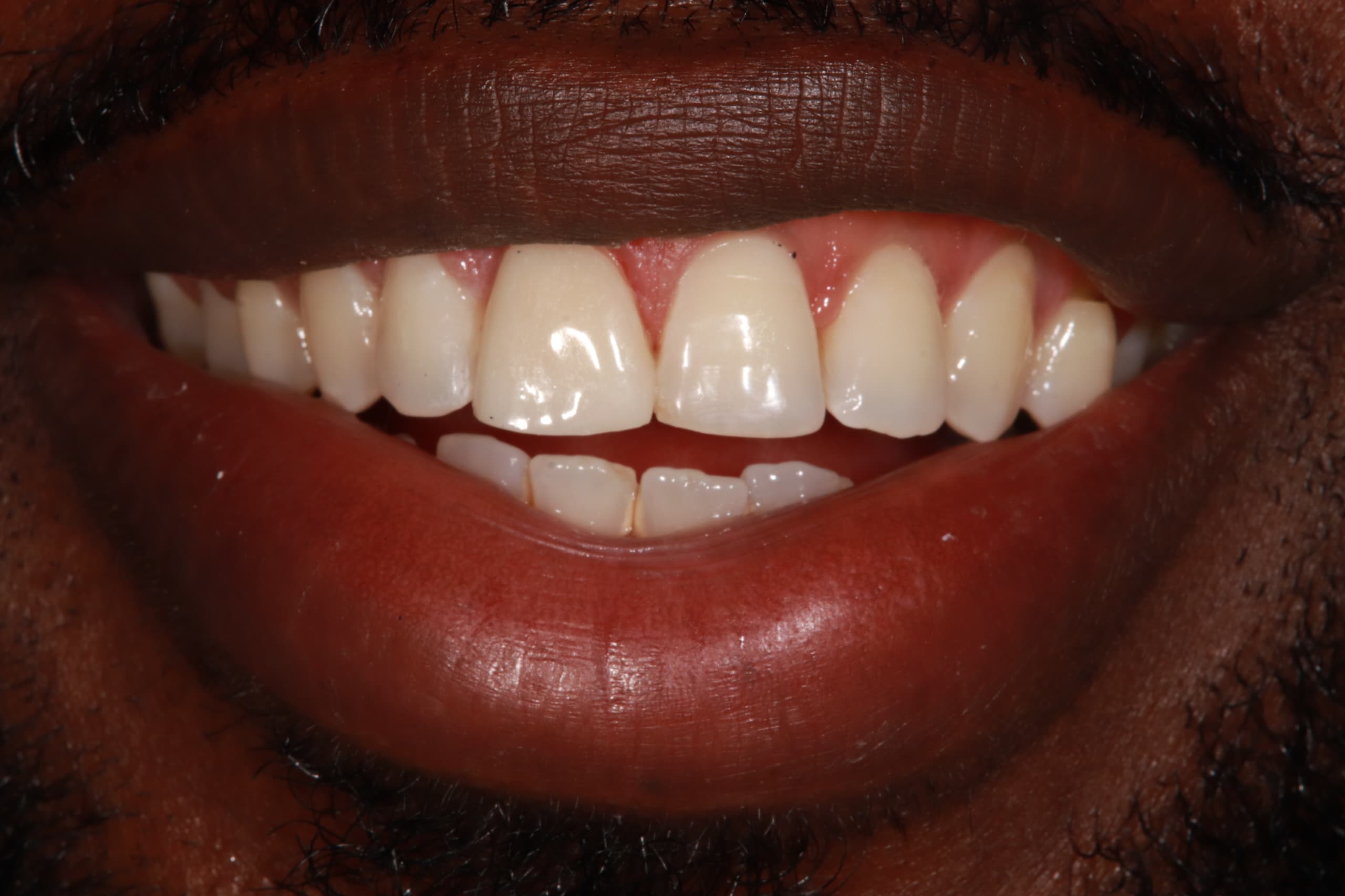 After treatment