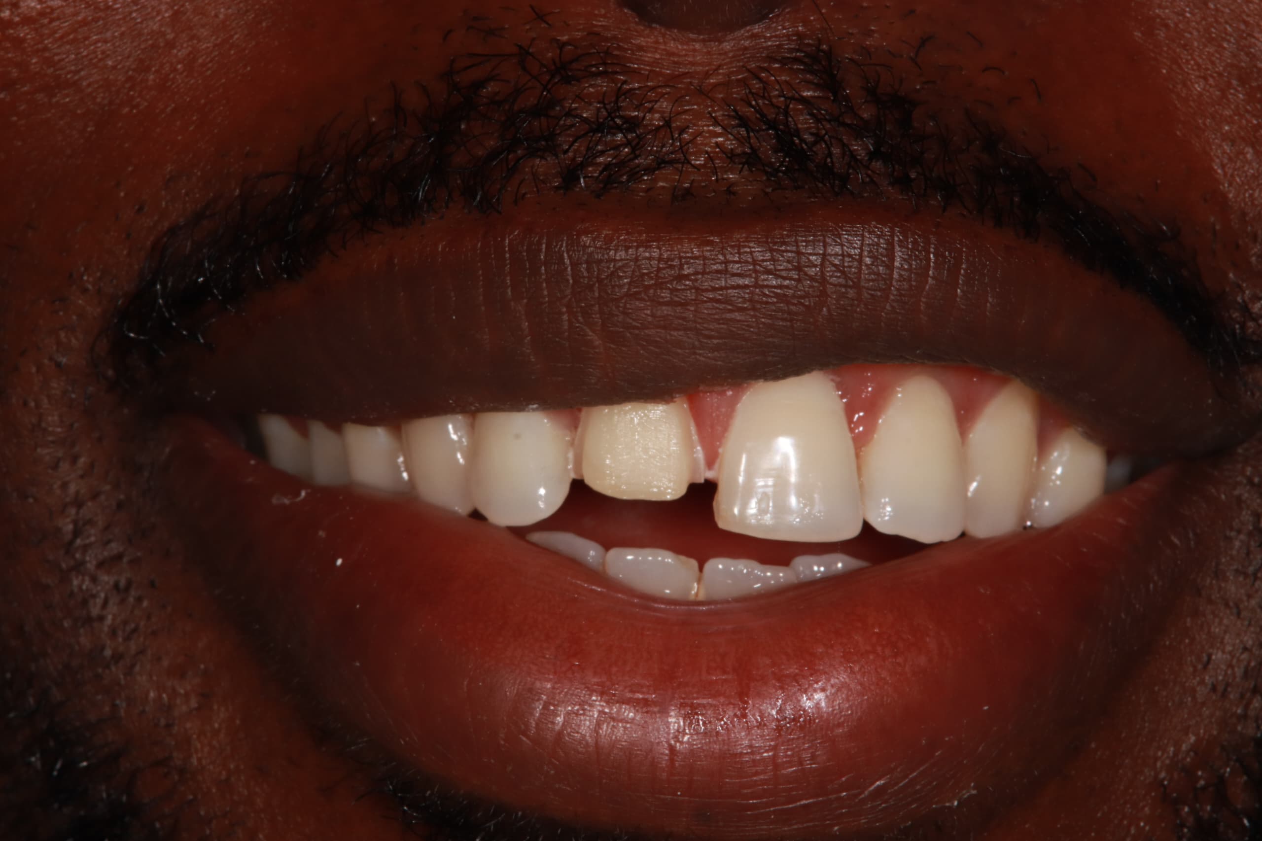 Before treatment