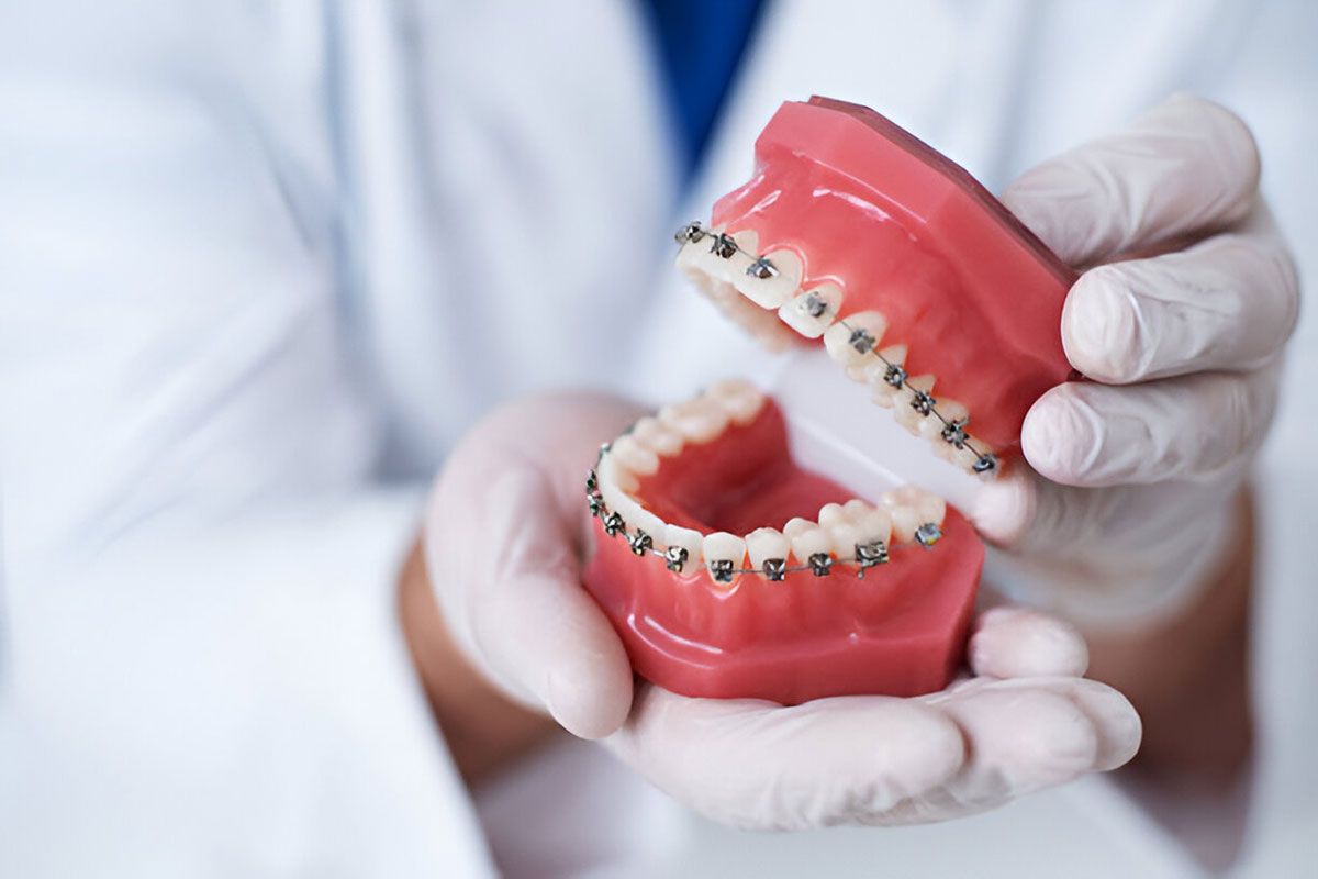braces installation at zoomexclusive dental care