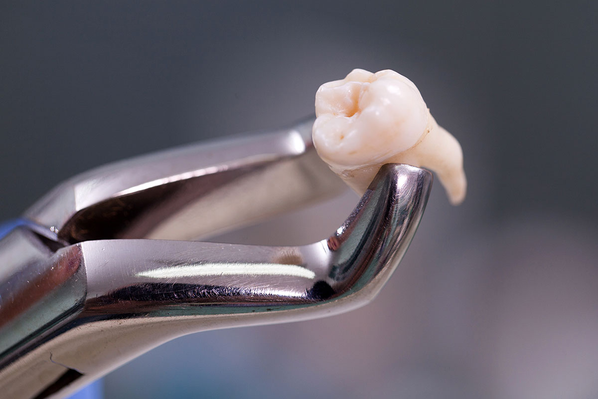 veneers installation at zoomexclusive dental care